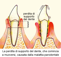 parodontite